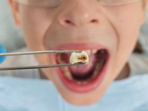 Best Emergency Wisdom Teeth Removal in Foxfire, NC